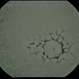Reticular Pattern Dystrophy Reticular Pattern Dystrophy