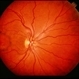 Reticular Pattern Dystrophy Reticular Pattern Dystrophy