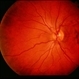 Reticular Pattern Dystrophy Reticular Pattern Dystrophy