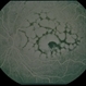 Reticular Pattern Dystrophy Reticular Pattern Dystrophy