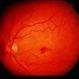 Reticular Pattern Dystrophy Reticular Pattern Dystrophy
