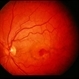 Reticular Pattern Dystrophy Reticular Pattern Dystrophy