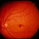 Reticular Pattern Dystrophy Reticular Pattern Dystrophy