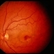Reticular Pattern Dystrophy Reticular Pattern Dystrophy