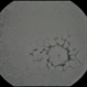 Reticular Pattern Dystrophy Reticular Pattern Dystrophy