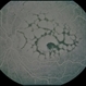 Reticular Pattern Dystrophy Reticular Pattern Dystrophy