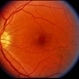 Solar Retinopathy Solar Retinopathy