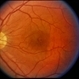 Solar Retinopathy Solar Retinopathy