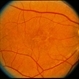 Pattern Dystrophy Pattern Dystrophy
