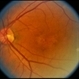 Pattern Dystrophy Pattern Dystrophy