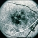 Pattern Dystrophy Pattern Dystrophy