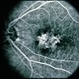 Pattern Dystrophy Pattern Dystrophy