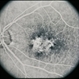 Pattern Dystrophy Pattern Dystrophy