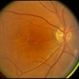Pattern Dystrophy Pattern Dystrophy