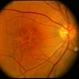 Pattern Dystrophy Pattern Dystrophy