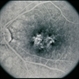 Pattern Dystrophy Pattern Dystrophy