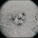 Pattern Dystrophy Pattern Dystrophy