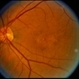 Pattern Dystrophy Pattern Dystrophy