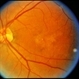 Pattern Dystrophy Pattern Dystrophy