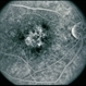 Pattern Dystrophy Pattern Dystrophy