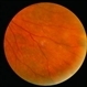 Senile Vitritis / Reticulum Cell