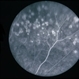 Senile Vitritis / Reticulum Cell