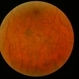 Senile Vitritis / Reticulum Cell