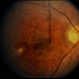 Diffuse Unilateral Subacute Neuroretinitis (DUSN) Diffuse Unilateral Subacute Neuroretinitis (DUSN)