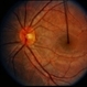 Diffuse Unilateral Subacute Neuroretinitis (DUSN) Diffuse Unilateral Subacute Neuroretinitis (DUSN)
