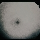 Plaquenil Toxicity Plaquenil Toxicity