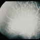 Plaquenil Toxicity Plaquenil Toxicity
