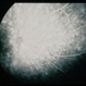 Plaquenil Toxicity Plaquenil Toxicity