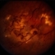 Coat's Disease