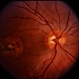 Coat's Disease