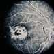 Coat's Disease