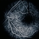 Coat's Disease