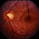 Coat's Disease