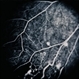 Coat's Disease
