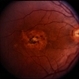 Coat's Disease