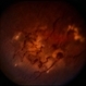 Coat's Disease