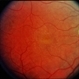 Basal Laminar Drusen / Cuticular Basal Laminar Drusen / Cuticular