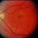 Basal Laminar Drusen / Cuticular Basal Laminar Drusen / Cuticular