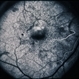 Basal Laminar Drusen / Cuticular Basal Laminar Drusen / Cuticular