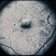 Basal Laminar Drusen / Cuticular Basal Laminar Drusen / Cuticular