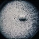 Basal Laminar Drusen / Cuticular Basal Laminar Drusen / Cuticular