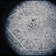 Basal Laminar Drusen / Cuticular Basal Laminar Drusen / Cuticular