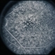 Basal Laminar Drusen / Cuticular Basal Laminar Drusen / Cuticular