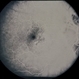 Nevus With CNVM Nevus With CNVM