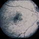 Nevus With CNVM Nevus With CNVM