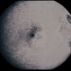 Nevus With CNVM Nevus With CNVM